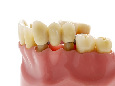All About Dental bridges - types, procedures, benefits, drawbacks, and more!